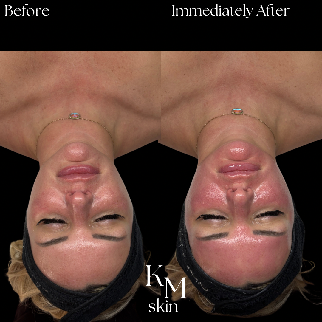 GlowX Treatment