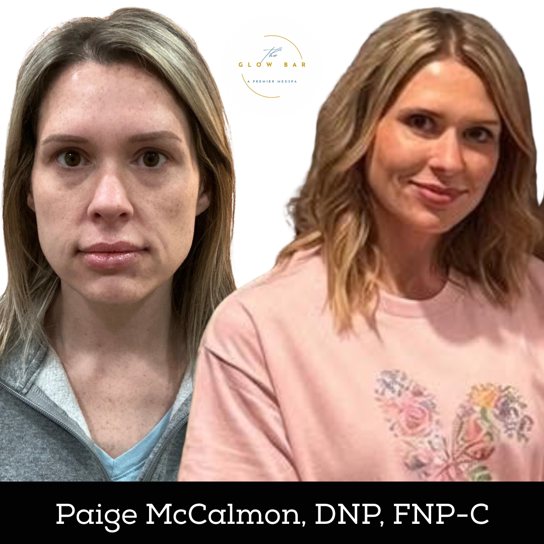 Jawline Tightening/Ozempic face filler