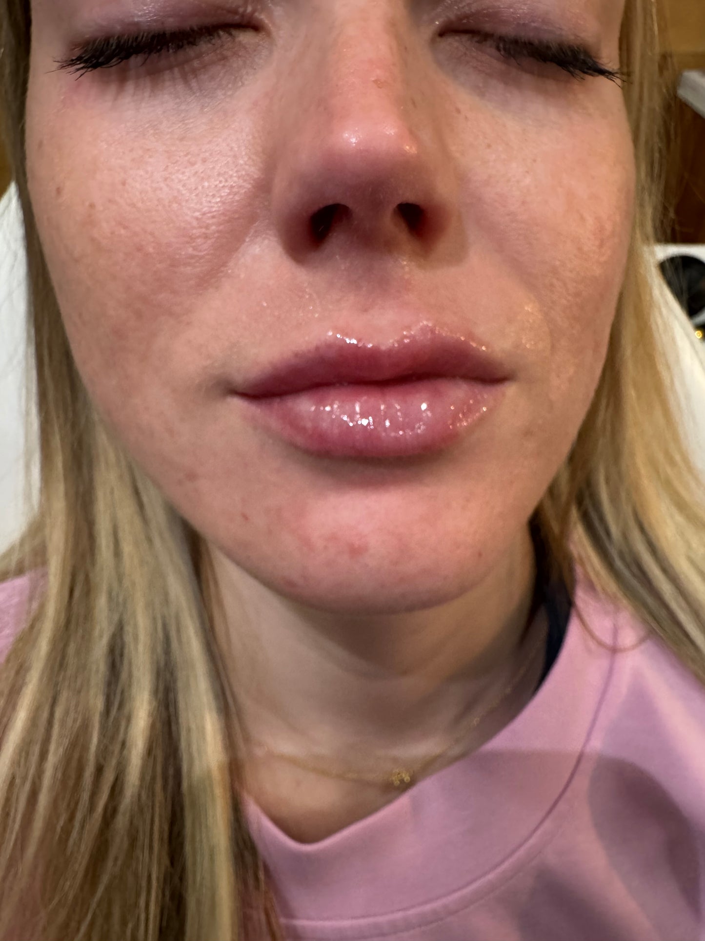 1 syringe of filler