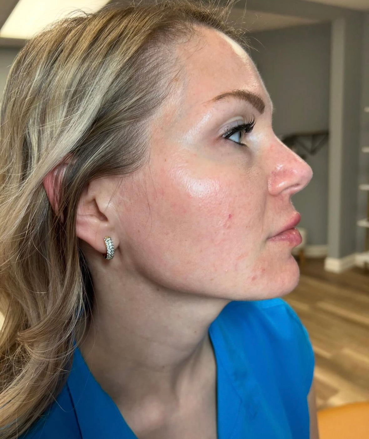 Facial Glossing with Filler