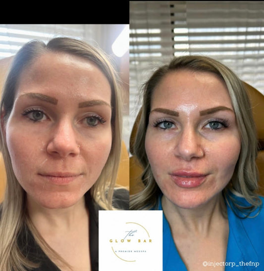 Facial Glossing with Filler