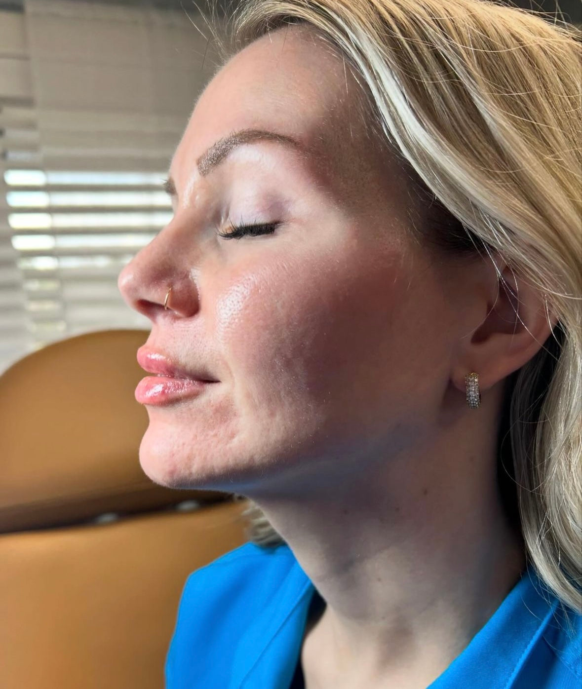 Facial Glossing with Filler