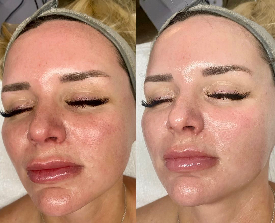 Glo2 Facial -Platinum