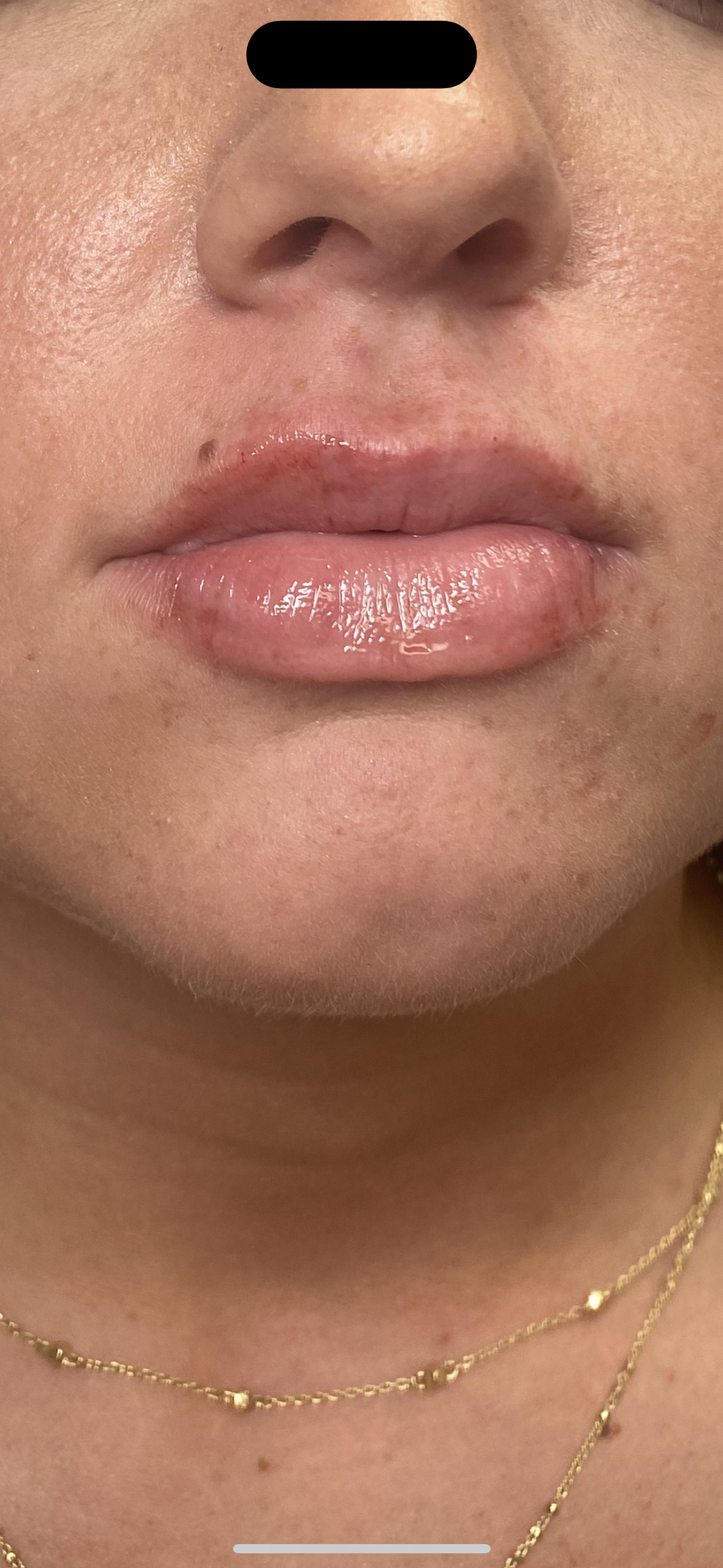 1 syringe of filler