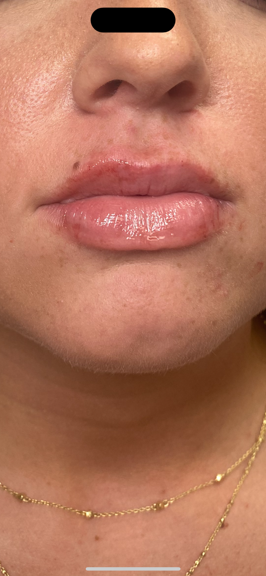 1 syringe of filler