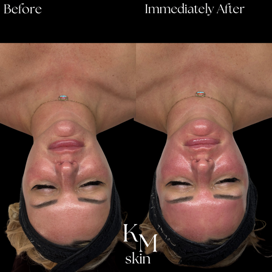 GlowX Treatment