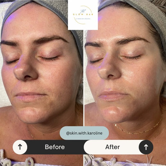 Platinum Hydrafacial